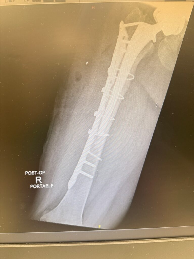 Legg-Calvé-Perthes disease right femur X-ray after hardware removal and femur fracture repair