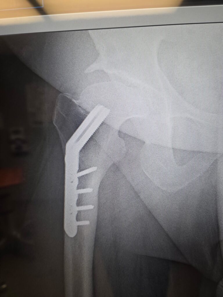 Legg-Calvé-Perthes disease right hip X-ray showing original surgical plate and screws